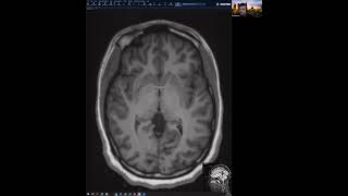 Approach to Pediatric Neuroimaging by Dr Kish Part I [upl. by Aderfla]