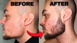 Minoxidil Beard Before And After  2 Months Progress [upl. by Attenyt]