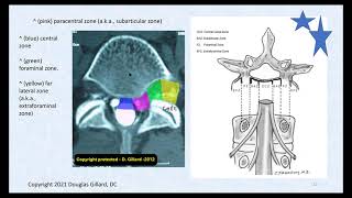 3 Key Ligaments of the Lumbar Spine and Their Related Pathology Disc Herniation Stenosis amp DISH [upl. by Carson]