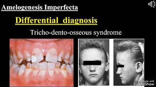 Amelogenesis Imperfecta Dr  Safaa Bassam Shihabi [upl. by Nylinnej]