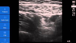 Ultrasoundguided Adductor Canal Block [upl. by Telrats]