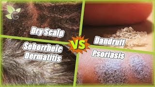 Dry Scalp vs Dandruff vs Seborrheic Dermatitis vs Psoriasis [upl. by Natividad]