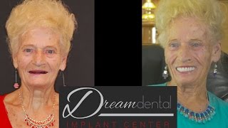 Dentures vs Allon4 Dental Implants She had dentures for 30 years [upl. by Hayalat]