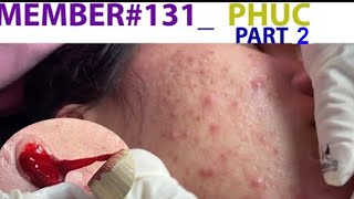 Acne Treatment Huong Da Nang 131 MEMBER Phuc Part 2 [upl. by Attennaj]