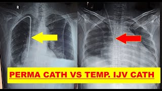 PERMA CATH VS TEMPORARY IJV HD CATHETER VIDEO 210  EXAM SPOTTERS [upl. by Esau]