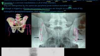 96P Introduction to the Seronegative Spondyloarthropathies [upl. by Ybsorc]