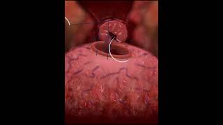 Rectal prolapse surgery  animationshorts shortsfeed youtubeshorts viralshorts [upl. by Belshin637]