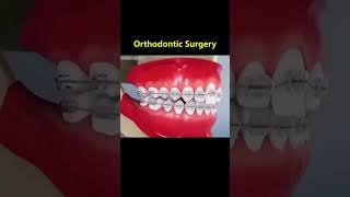 Ortho Treatment open bite العلاج التقويم للعظه المفتوحه 🎖️👌 [upl. by Anauqahc89]