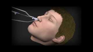 Balloon Sinuplasty Procedure Animationwmv [upl. by Bergstrom948]