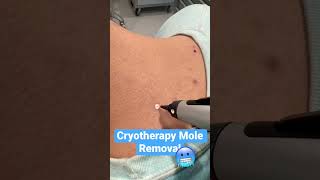 Cryotherapy MOLE REMOVAL Treatment 🥶❄️ [upl. by Applegate]