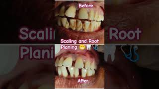 Oral Hygiene Scaling and Root planing conventional periodontal therapybdshorts dental smile [upl. by Dov]