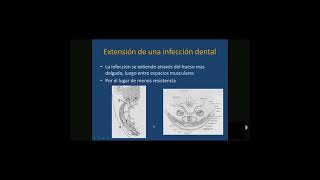 INFECCION MAXILOFACIAL dentist gestiondental innovation cirugiageneral maxilofacial [upl. by Darcia]