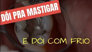 O QUE FAZER EM MOLAR INFERIOR COM DOR À MASTIGAÇÃO E AO FRIO [upl. by Enelear]