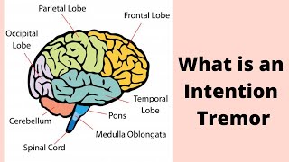 What is an Intention Tremor [upl. by Eikcin]