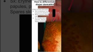 How to differentiate diaper dermatitis [upl. by Halilak937]