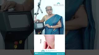 Q Switch Laser  Tamil  Dr Yamini  Dermatologist  Helios Skin Hair and Laser Clinic  Chennai [upl. by Ahsienal]