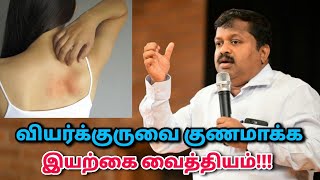 வியர்க்குரு குணமாக உடல் சூடு குறைய பாட்டி வைத்தியம்  DrSivaraman speech on heat rash remedy [upl. by Aynom660]