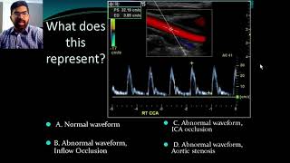 Secrets of Carotid Ultrasound [upl. by Latimer155]