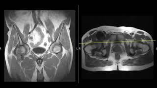 Anterior hip pain in 57 year old [upl. by Aztilay]