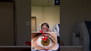 Eye doctor explains why most cataract patients experience day blindness Symptoms of cataract [upl. by Hellman]