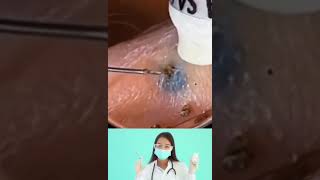 DrNattacha blackheads extraction surprise [upl. by Ahsitram]