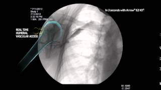 Arrow® EZIO® Infusion Fluoroscopy Proximal Humerus MC000631 [upl. by Nauqit]