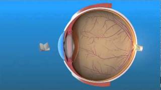 Presbyopia [upl. by Cello]