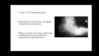 Charcot Joint GK SINGH ELMCH [upl. by Polak475]