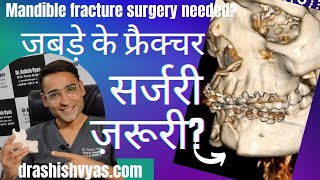 जबड़े के फ्रैक्चर में ऑपरेशनSurgery for Mandible fracture needed or not [upl. by Gypsy]