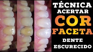 🛑TÉCNICA COM 3 PASSOS PARA FACETAS EM DENTES ESCURECIDOS🔥🔥🔥🚀 [upl. by Htims]