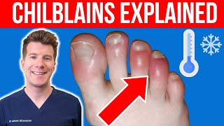 Doctor explains CHILBLAINS Pernio  Causes symptoms and treatment [upl. by Damaris495]