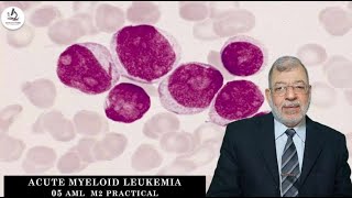 Acute Myeloid Leukemia 05 M2 Practical [upl. by Edak501]