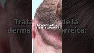 DERMATITIS SEBORREICA caspa TRATAMIENTO [upl. by Malory]