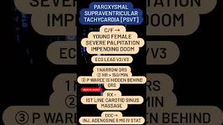 PAROXYSMAL SUPRAVENTRICULAR TACHYCARDIA PSVT [upl. by Deraj]