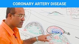 Coronary Artery Disease  Ischemic Heart Disease  Angina🫀 [upl. by Ttergram433]