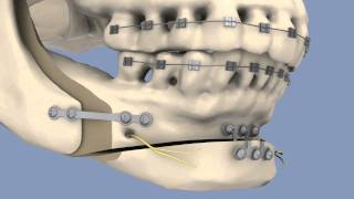 BSSO amp Osseous Genioplasty [upl. by Merete]