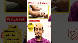 Edema क्या होता है  इसके Types क्या होते है  edema swelling shortsfeed [upl. by Arahset]