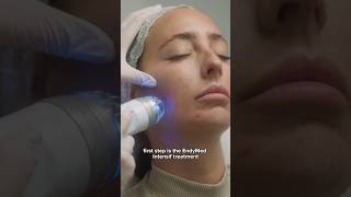 EndyJET The combo of RF Microneedling amp Agejet Plasma  Dr Medispa [upl. by Hcaz273]