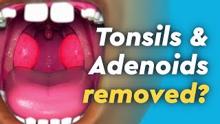 Tonsils and Adenoids Surgery [upl. by Nalda]