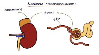 Hyperaldosteronism and Conns Syndrome [upl. by Ssej]