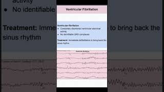 Ventricular Fibrillation [upl. by Iny]