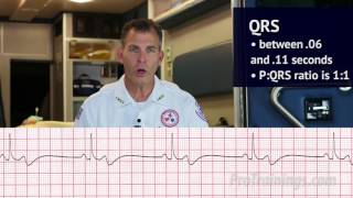 Bradycardia ECG Rhythm Interpretation [upl. by Painter659]