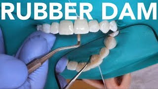 Rubber Dam Placement for Anterior amp Posterior Teeth [upl. by Corbett]