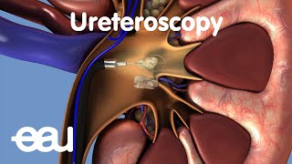 Removal of kidney stones URS [upl. by Kcirdahs]