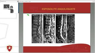 ESPONDILITE ANQUILOSANTE AULA AO VIVO COMPLETA FACULDADE FINACI [upl. by Nortal]
