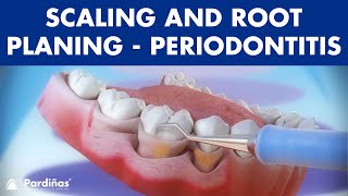 Treatment of periodontal disease  Scaling and root planing  Tartar © [upl. by Rolandson]