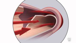 Spontaneous coronary artery dissection SCAD Animation [upl. by Halden126]