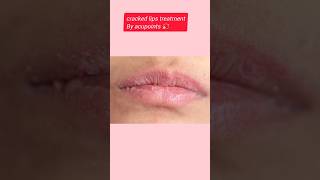 Cracked lips treatment by Acupressure pointsytshorts shorts [upl. by Yrallih]