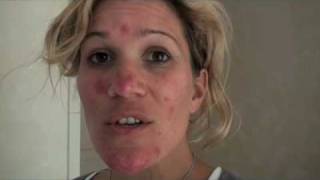 Gaining humility from Rosacea It got worse amp I am now starting antibiotics [upl. by Mandler]