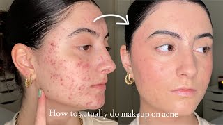 How to Make Makeup Look Smooth amp Natural on Acne and Textured Skin [upl. by Drida]